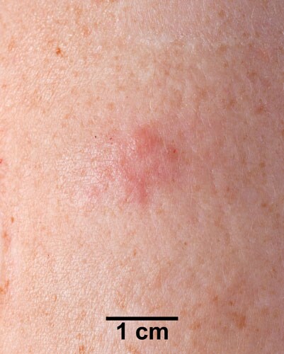 An arm with a small rash