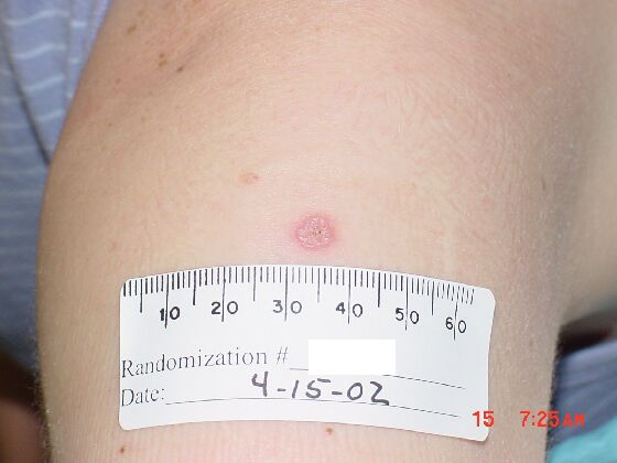 An upper arm with a red lesion