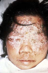 A child's face covered in eczema vaccinatum scabs, particularly over the forehead and eyes