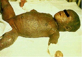 An infant lay on a bed, their torso, arms, legs, and head covered in rash and scabs