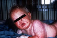 An infant with a red rash all over