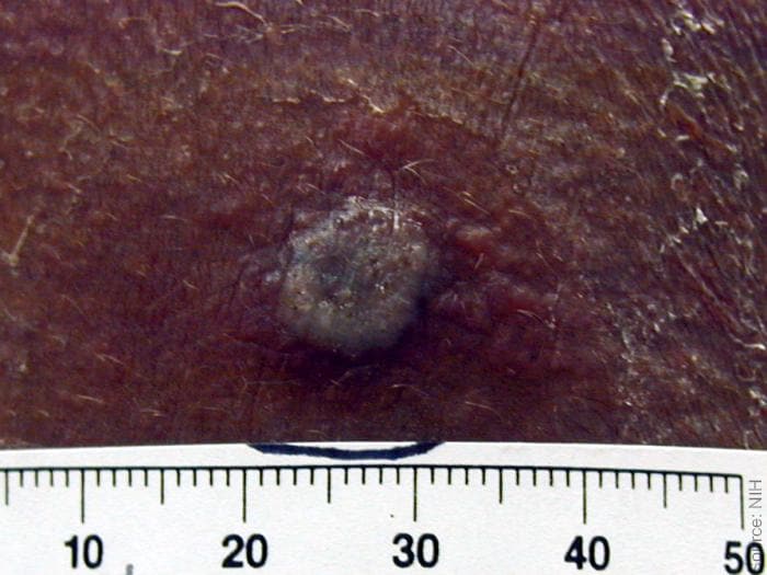 A raised greyish lesion on dark skin