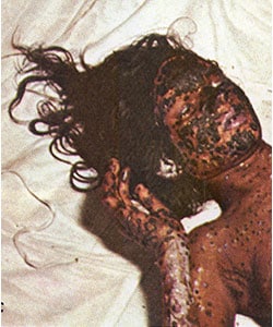 A young woman lies on a bed, covered in bleeding smallpox pustules on her head, arm, hands, and chest.