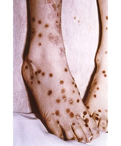 Feet covered in smallpox lesions