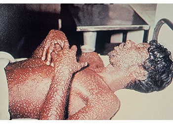 A male lies on a bed, covered in smallpox lesions