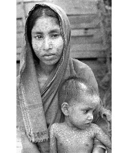 A woman holding a child, both with smallpox scars