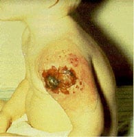 A small child with a large lesion on their arm