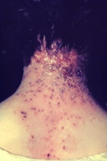 The back of a woman's neck, covered in a rash.