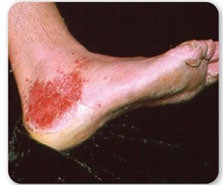 Vista lateral de pie mostrando enrojecimiento e irritaci%26oacute;n alrededor del tobillo
