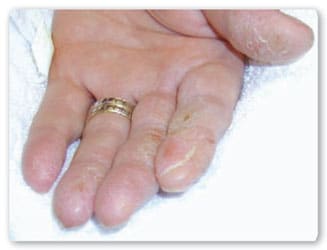 Vista de mano hacia arriba con los dedos mostrando dermatitis de contacto al%26eacute;rgico