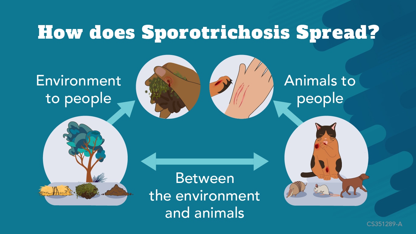 Sporotrichosis Basics | Sporotrichosis | CDC