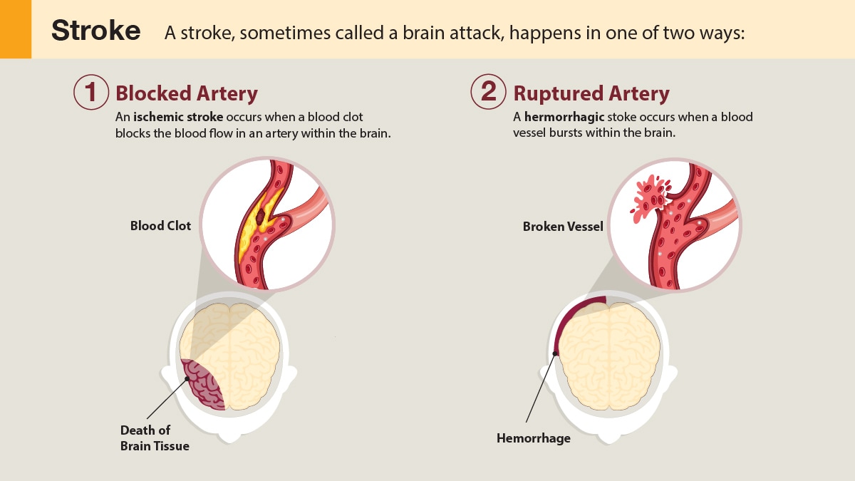 stroke causes