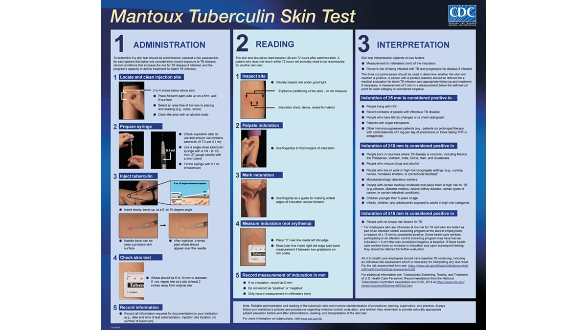 The Mantoux Tuberculin Skin Test Wall Chart provides a convenient reference for health care workers who administer and read the skin test. The first two panels of the wall chart list the key steps in administration and reading of the skin test and features close-up photographs. The third panel describes how to interpret the skin test results.
