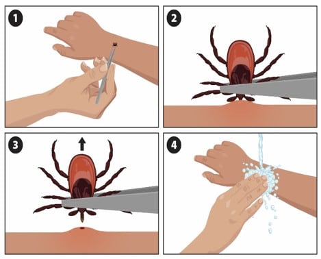 Ilustración que muestra cómo sacar una garrapata (imagen de Ixodes scapularis).