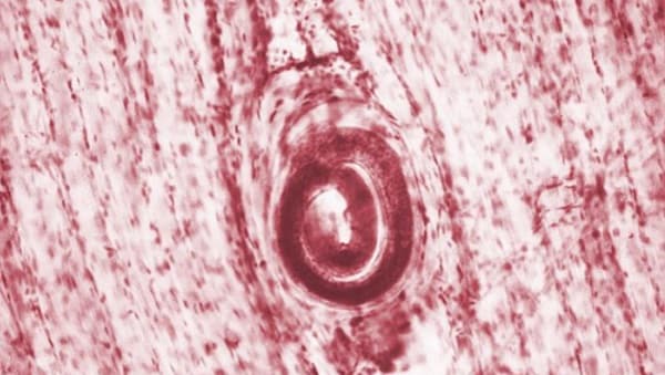 Trichinella-spiralis-cyst