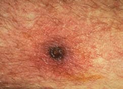 Scrub Typhus | Typhus Fevers | CDC