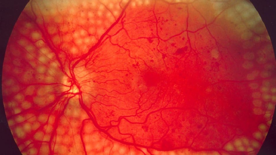eyeball showing treatment of diabetic retinopathy