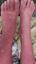 Two legs shown from the mid-shin to the toes, with widespread red rash and splotchy white spots