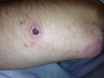 An arm with a pink/red rash and a single tick bite.