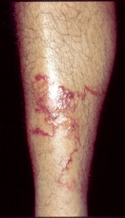 A lower leg with winding, blistering, raised, red lines or tracks on the skin.