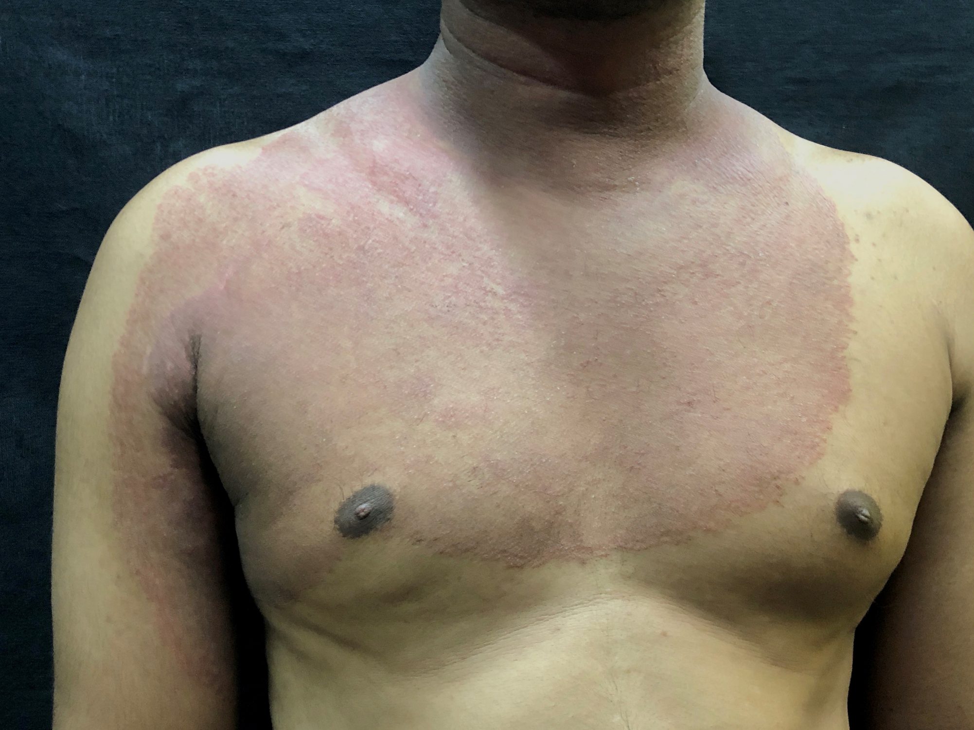 A torso with a widespread red area covering most of the upper chest, neck, and part of the upper arm.