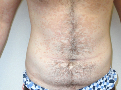 A torso with a patchy, red rash covering much of the area of the torso.
