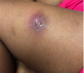 An appendage with a red bump on the skin that has a small, scabby opening in the center.