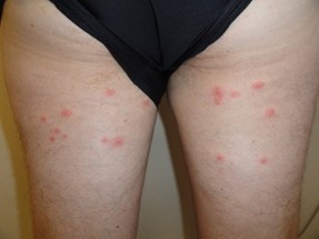 Legs with red bumps/clusters sporadically spread over the skin.