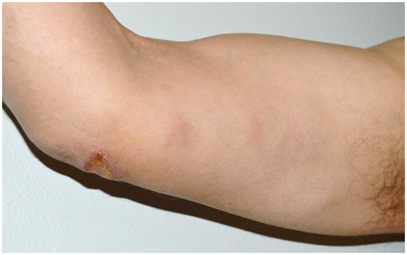 An inner, upper arm with several pink and red skin lesions.
