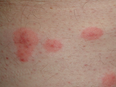 A zoomed in photo of red, rashy bumps/clusters spread over the skin.