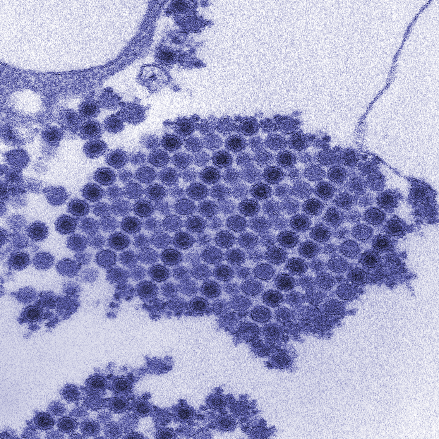 This image shows numerous Chikungunya virus particles composed of a central dense core, surrounded by a viral envelope.